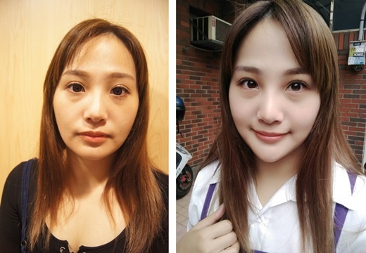 台中醫美推薦ptt,台中整形外科,台中醫美推薦,台中醫美診所,台中玻尿酸,台中打玻尿酸,台中打玻尿酸,台中玻尿酸推薦,台中肉毒,台中打肉毒,台中肉毒推薦,台中肉毒桿菌,台中醫美價格,台中醫美評價,台中醫美價錢,台中玻尿酸價格,台中玻尿酸評價,台中玻尿酸介紹,台中玻尿酸價錢,台中玻尿酸評論,台中玻尿酸推薦,台中肉毒價格,台中肉毒評價,台中肉毒介紹,台中肉毒價錢,台中肉毒推薦,台中整形外科,台中醫美診所,台中玻尿酸整型,打肉毒瘦臉微整,台中微整醫美